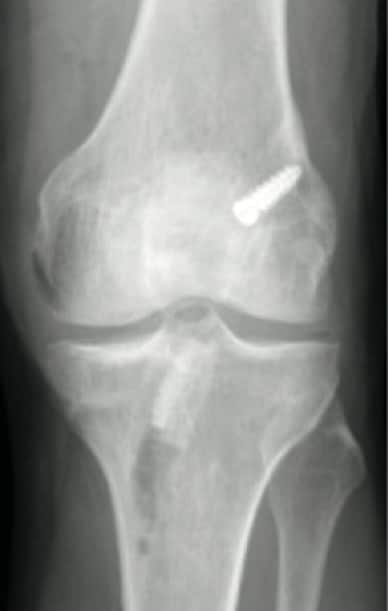 Postoperative radiograph of anterior-posterior view